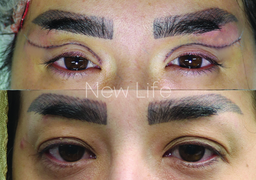 راهنمای انتخاب جراحی پلک مناسب سن و جنسیت