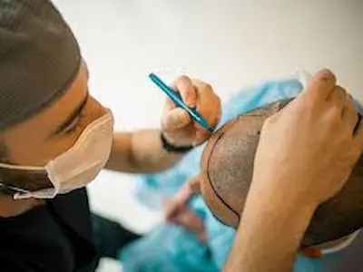 بازگشت اعتماد به نفس با کاشت مو: همه‌چیز درباره روش‌های مدرن
