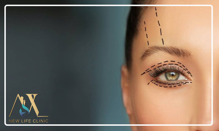 بهترین سن بلفارو پلاستی