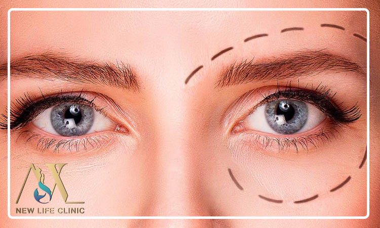 بهترین سن بلفارو پلاستی