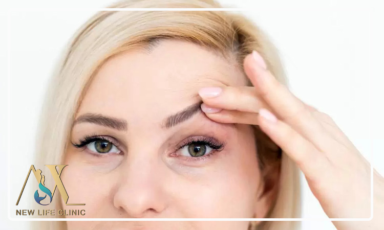 بهترین سن بلفارو پلاستی