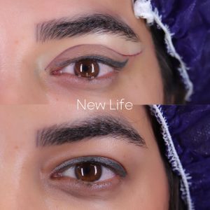 بلفارو پلاستی