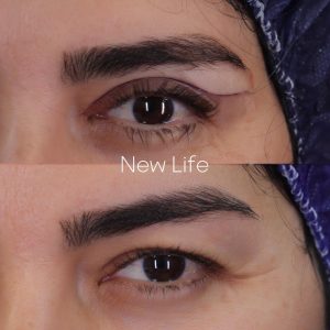 بلفارو پلاستی