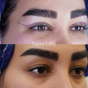 بلفارو پلاستی