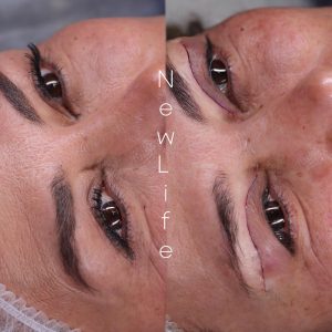 بلفارو پلاستی