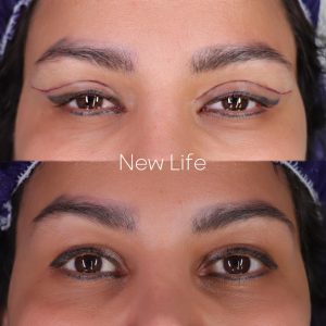 بلفارو پلاستی