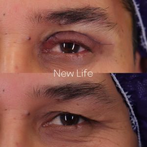 بلفارو پلاستی