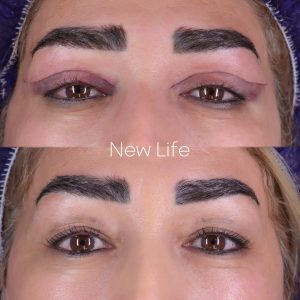 بلفارو پلاستی