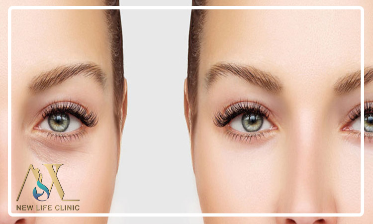 مقایسه بلفاروپلاستی و تزریق بوتاکس دور چشم در جوانسازی چشم ها