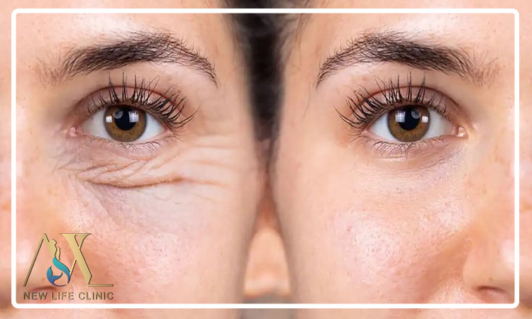 مقایسه بلفاروپلاستی و تزریق بوتاکس دور چشم در جوانسازی چشم ها