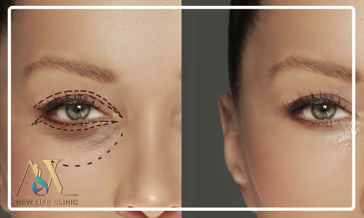 مقایسه بلفاروپلاستی و تزریق بوتاکس دور چشم در جوانسازی چشم ها