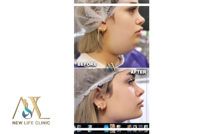 لیپو فیس غبغب