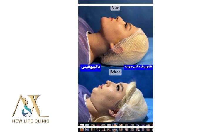 لیپو فیس غبغب