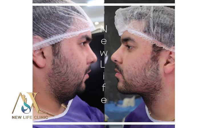 لیپو فیس غبغب