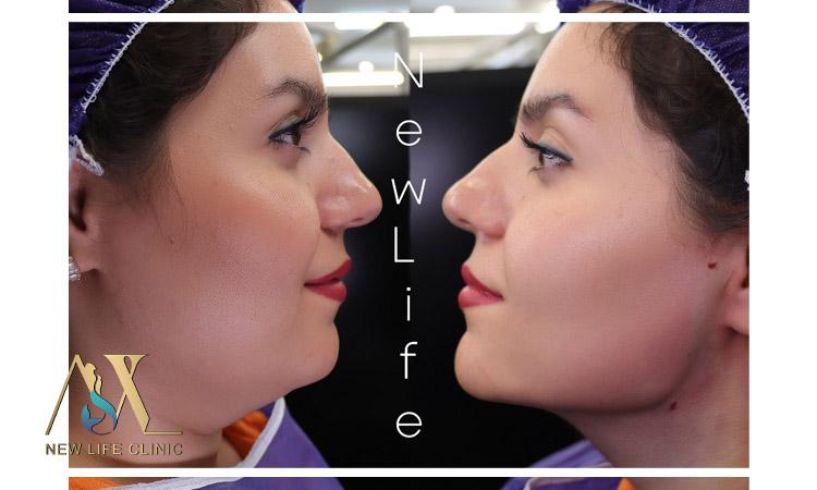 لیپو فیس غبغب