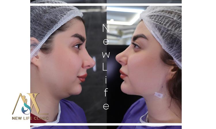 لیپو فیس غبغب