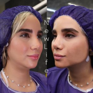 لیپو ساکشن غبغب