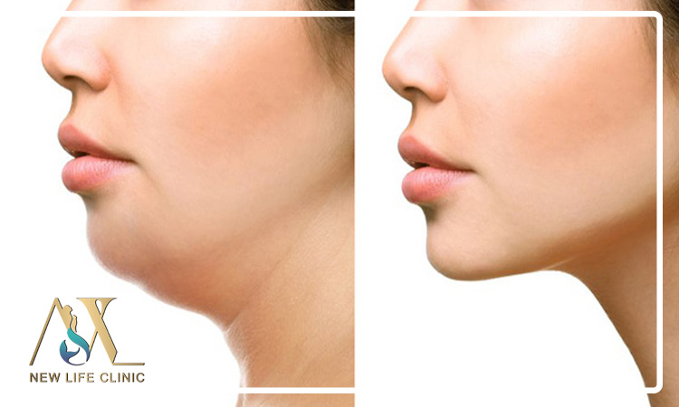 زاویه سازی صورت برای خانم ها با لیپو فیس