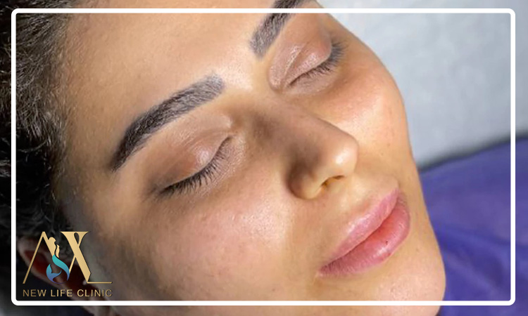 زاویه سازی صورت برای خانم ها با لیپو فیس