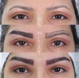 برداشت مو برای کاشت ابرو چگونه انجام می‌شود؟