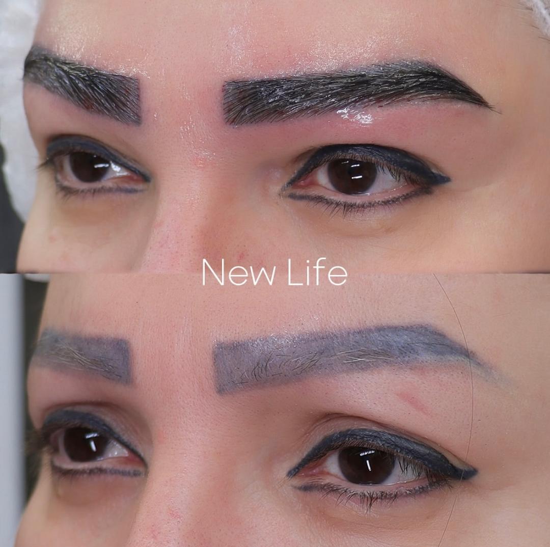 برداشت مو برای کاشت ابرو چگونه انجام می‌شود؟