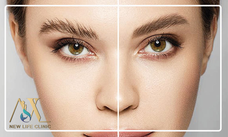 آیا کاشت ابرو طبیعی برای افرادی با پوست چرب مناسب است؟