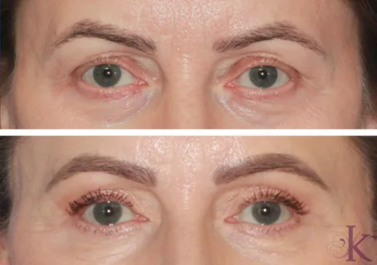 بلفاروپلاستی پلک پایین