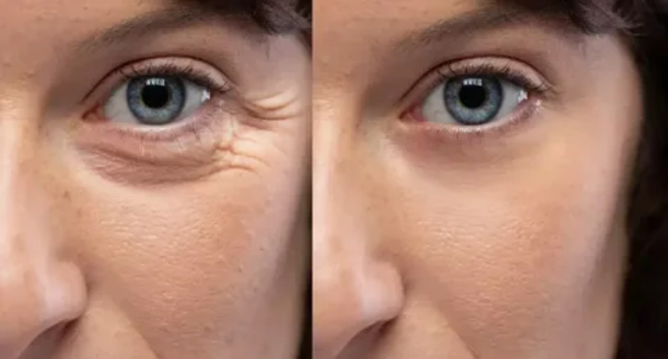 بلفاروپلاستی پلک پایین