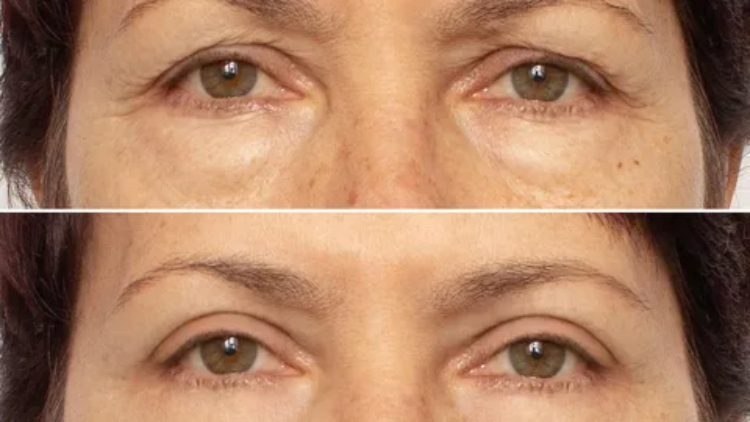 بلفاروپلاستی پلک پایین