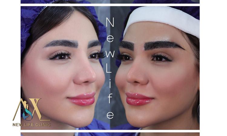 کاشت ابرو طبیعی