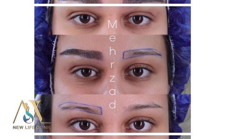 کاشت ابرو طبیعی
