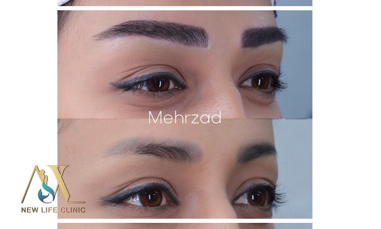 کاشت ابرو طبیعی 