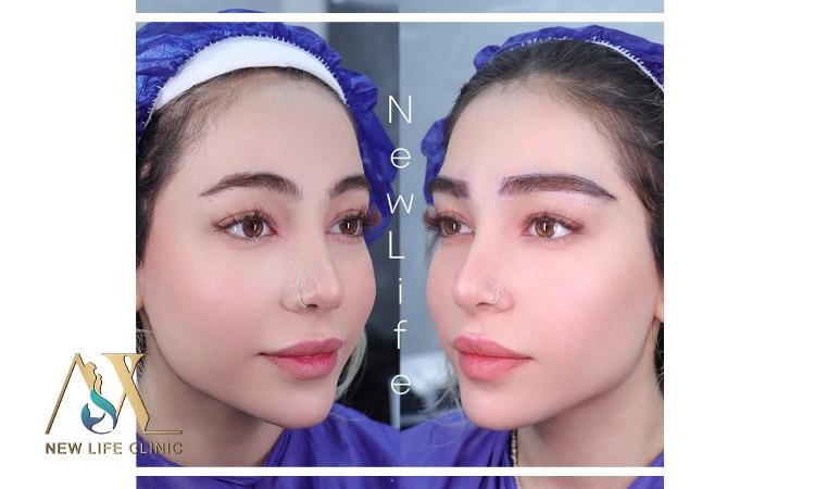 کاشت ابرو طبیعی 