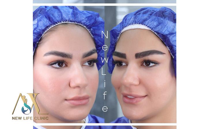 کاشت ابرو طبیعی