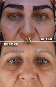Natural eyebrow transplantation using micro-implantation method