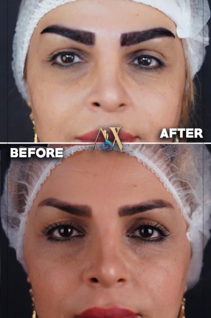 کاشت ابرو طبیعی به روش میکرو کاشت
