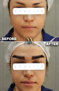 کاشت ابرو طبیعی به روش میکرو کاشت