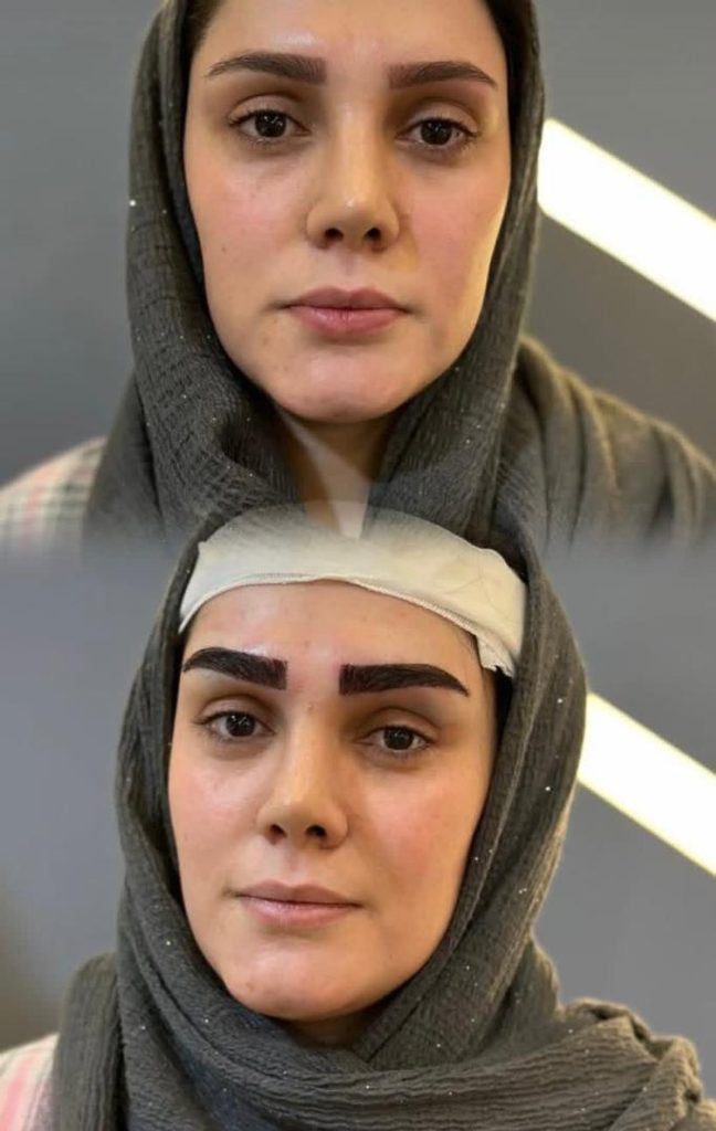 کاشت ابرو طبیعی به روش میکرو کاشت
