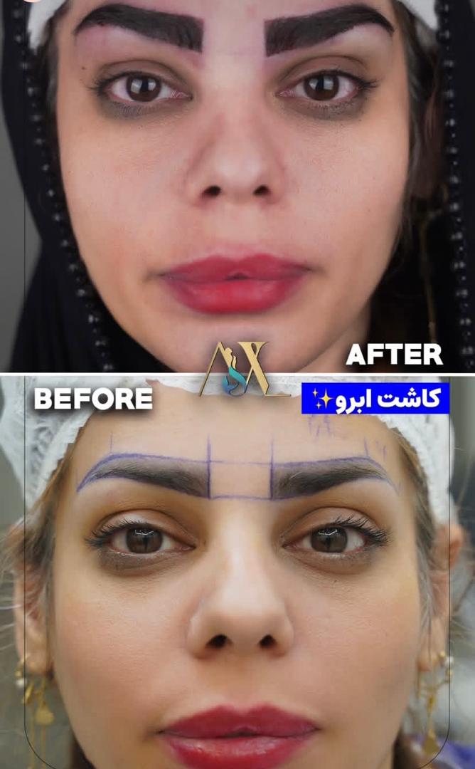 کاشت ابرو طبیعی به روش میکرو کاشت