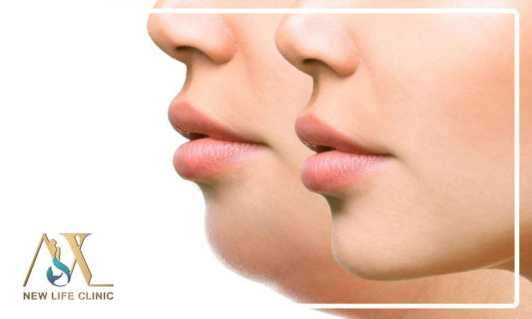 روش‌های علمی زاویه‌سازی فک و صورت