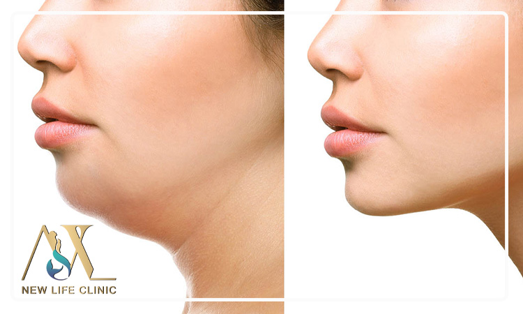 بهترین روش‌های لاغر شدن غبغب