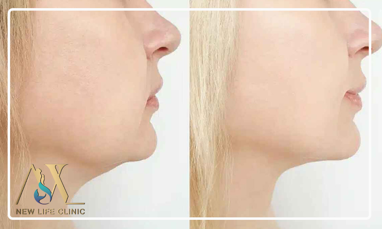 تأثیر لیپو فیس غبغب در رفع افتادگی فک