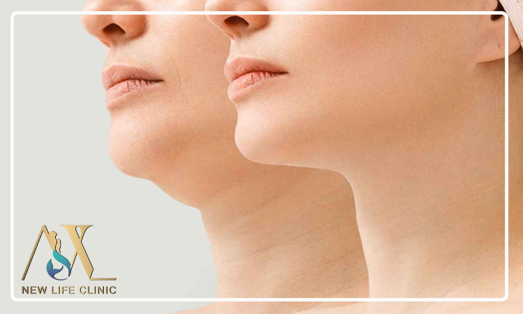 تأثیر لیپو فیس غبغب در رفع افتادگی فک