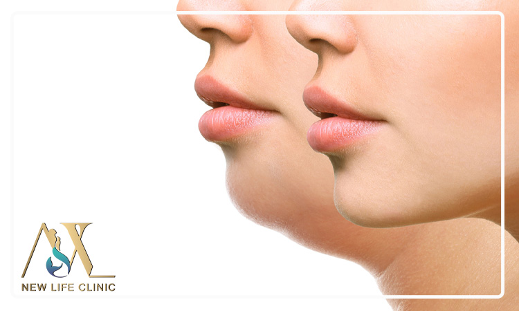 تأثیر لیپو فیس غبغب در رفع افتادگی فک