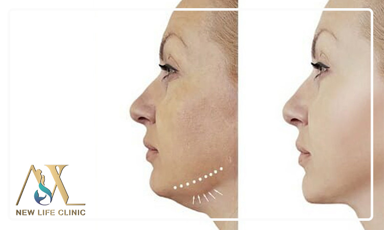 تأثیر لیپو فیس غبغب در رفع افتادگی فک