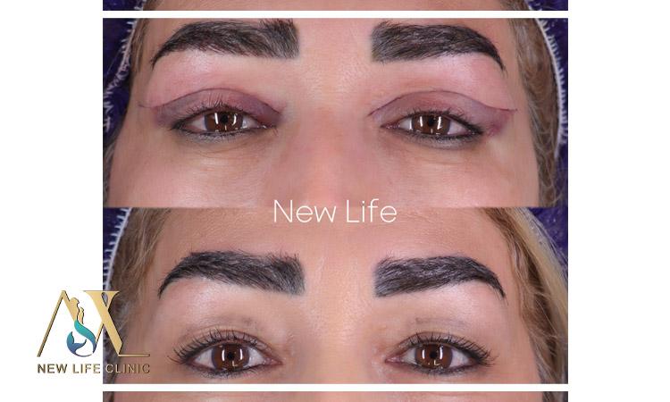 بلفاروپلاستی پلک بالا