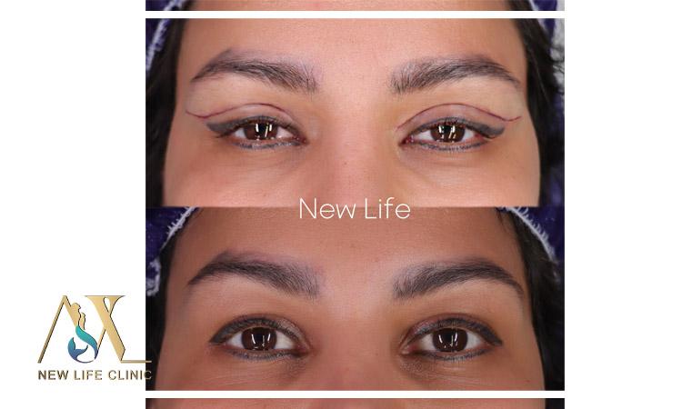 بلفاروپلاستی پلک بالا