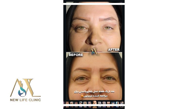 بلفاروپلاستی پلک بالا