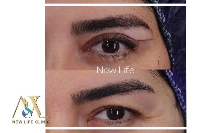 بلفاروپلاستی پلک بالا