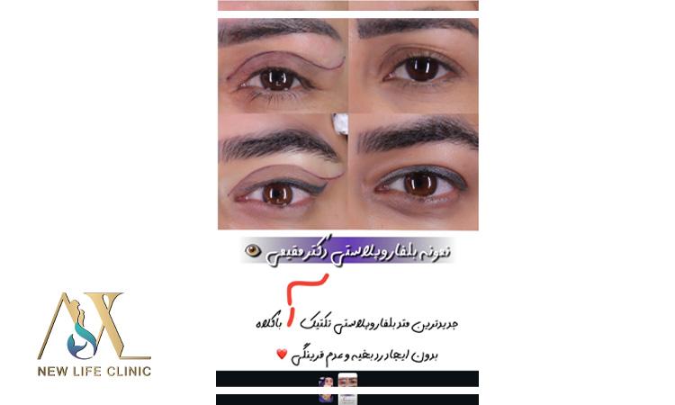 بلفاروپلاستی پلک بالا